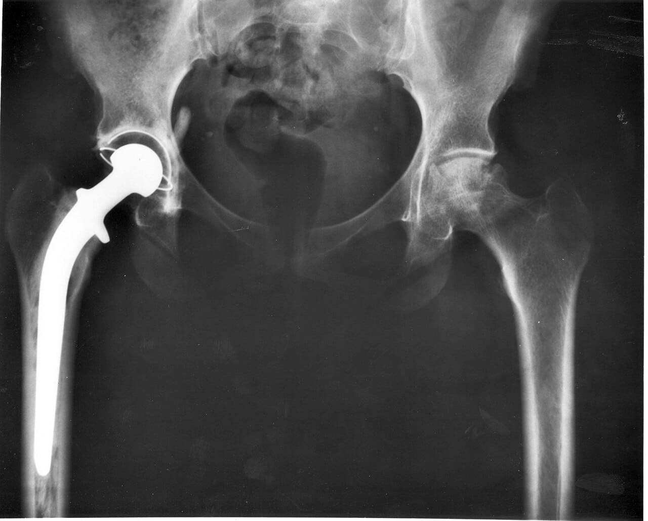 Pain and joint stiffness